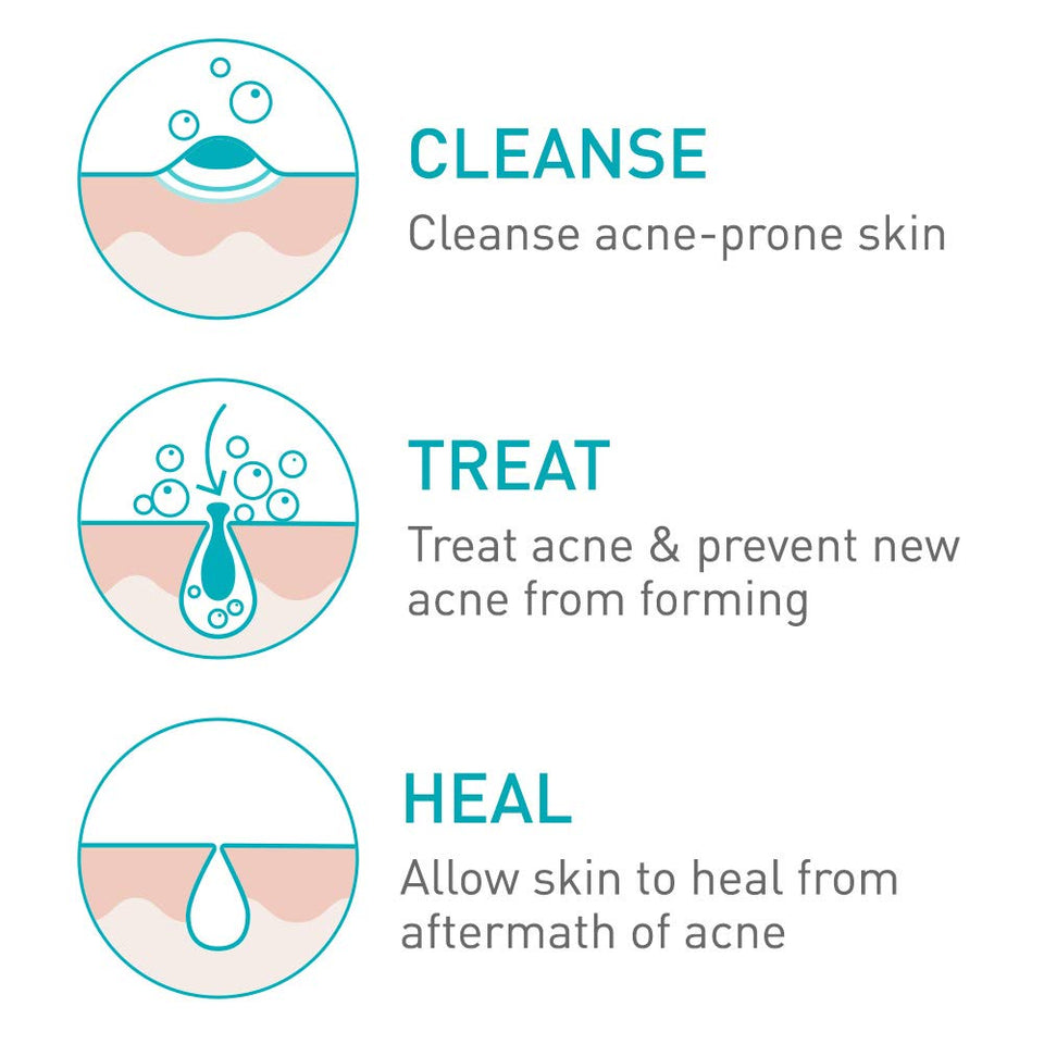 CeraVe Acne Foaming Cream Cleanser | Acne Treatment Face Wash with 4% Benzoyl Peroxide, Hyaluronic Acid, and Niacinamide | Cream to Foam Formula | 5 Oz