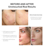 Murad InvisiScar Resurfacing Treatment for reducing the appearance of Acne Scars and Dark Spots, 0.5 Fl Oz